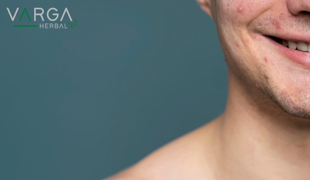 Pattanás vagy akne: a bőr kezelése