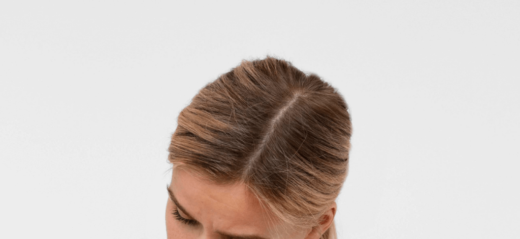 Hajhagyma gyulladás fejbőrön