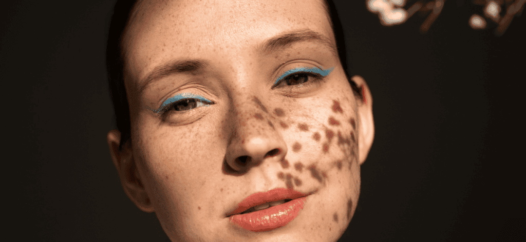 Pattanás okai: Tények és tippek a tiszta, egészséges bőrért