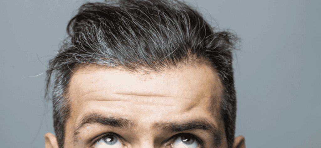 Seborrheás dermatitisz_ Hatékony megoldások a korpásodás ellen